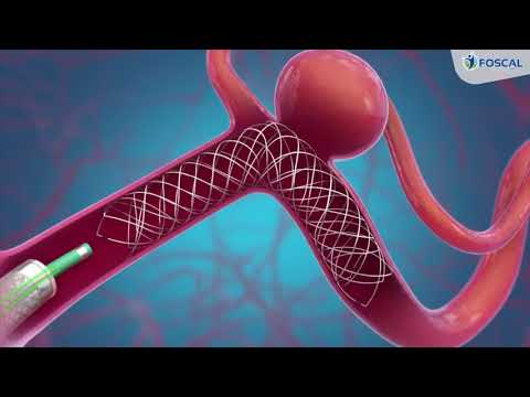 Video: Cómo recuperarse de un angiograma (con imágenes)