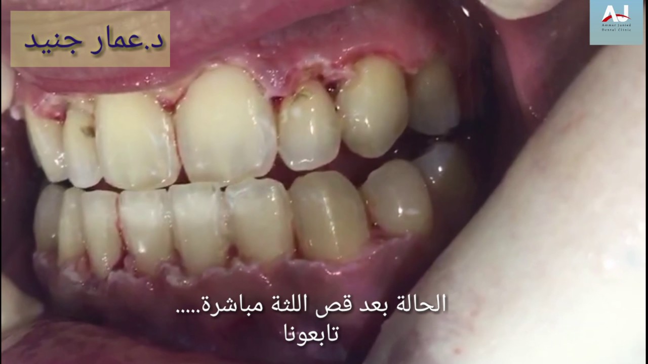 قص اللثة التجميلي بدون نزيف Youtube