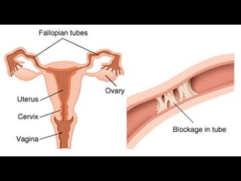 Video: A mund të lidhen tubat fallopiane?