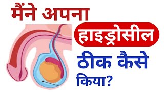 हाइड्रोसील ठीक कैसे करें? | Right hydrocele ka ilaj | दायाँ हाइड्रोसील में सूजन| Factz TV