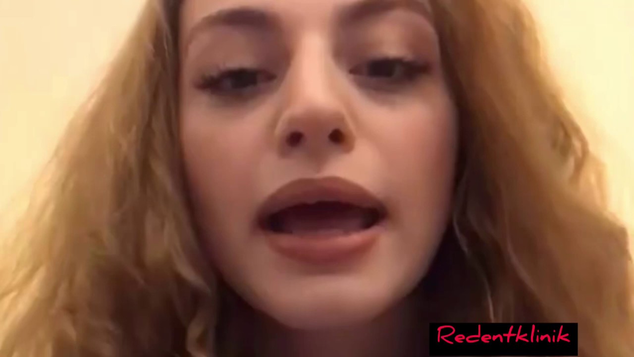 Cansın Hanım şeffaf plak tedavisinin nasıl olduğunu sizler için anlatmış☺️