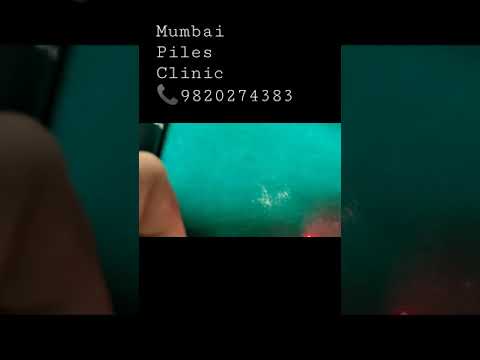 Bare fibre Biolitec Leonardo laser || Laser hemorrhoidoplasty/  sphincterolysis || Dr Sambit Patnaik