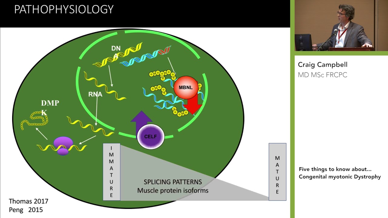 Five things to know about Congenital myotonic dystrophy with Craig Campbell, MD | MDC - DMC