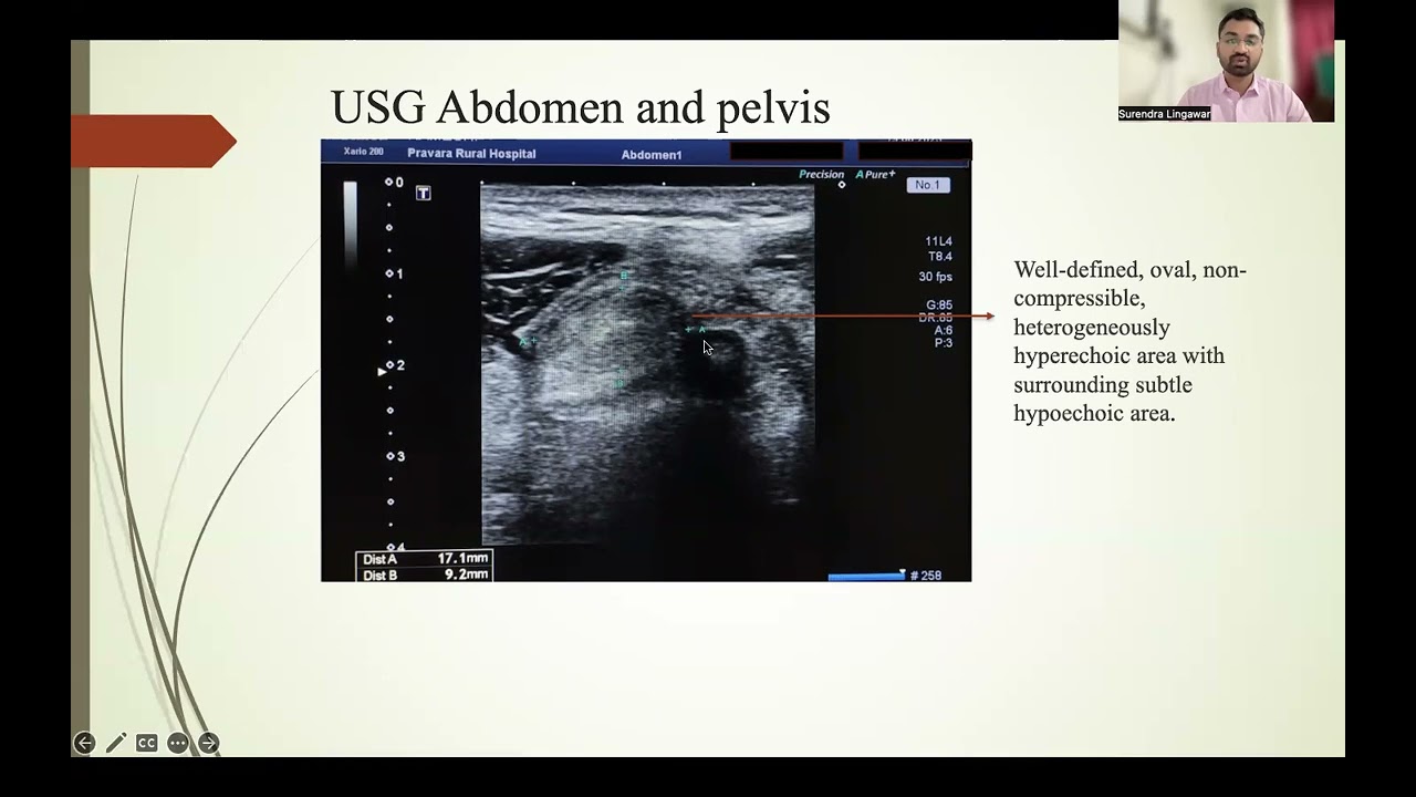 CTBUZZ2023-Dr. Surendra S Lingawar: Epiploic Appendigitis Presenting as Acute Abdomen.A Case Report