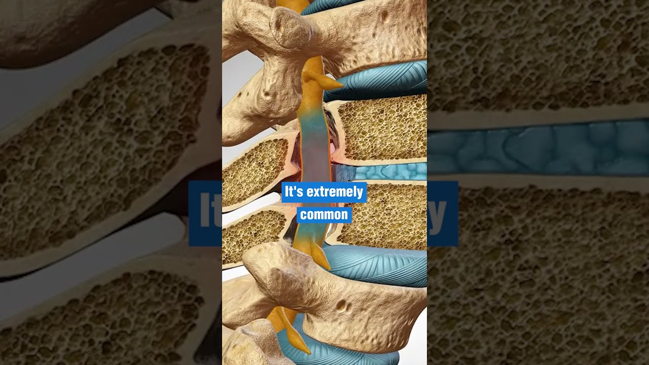 You May Have A Herniated Disc Or Bulging Without Knowing 