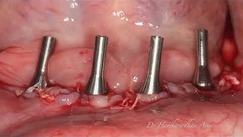 INTRA ORAL WELDING AND IMMEDIATE LOADING