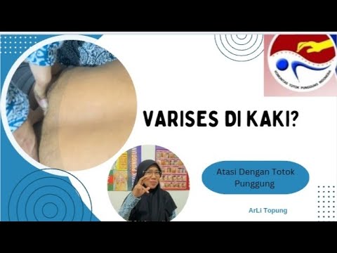 Cara Mudah Mengatasi Gejala Varises Dengan Totok Punggung