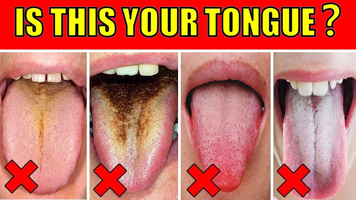 Descubre qué revela tu lengua sobre tu salud bucal