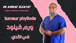 tumeur phyllode ورم فيلود في الثدي عند السيدات