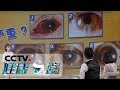 《健康之路》 眼睛红 不简单：这5种眼病会让眼睛发红 最后两种还会致盲 20190228 | CCTV科教
