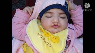 عملية الشفة الارنبية المزدوجة الحنك المشقوق cleft lip and palate ا.د. صابر عبد المقصود