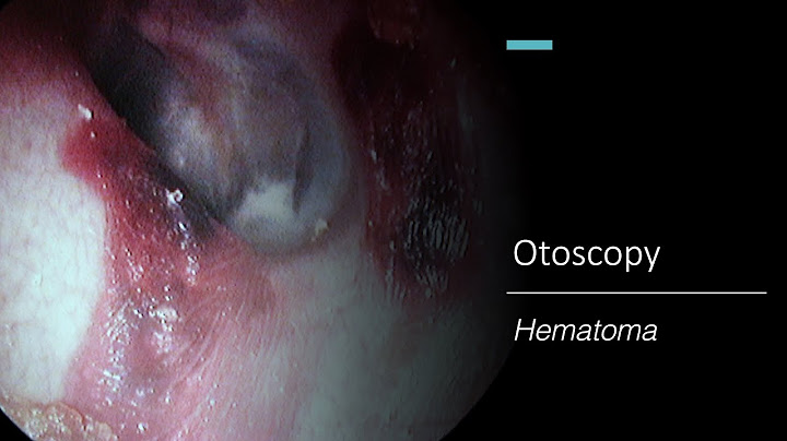 การด แลผ ป วยท ม hematoma หล ง off sheath