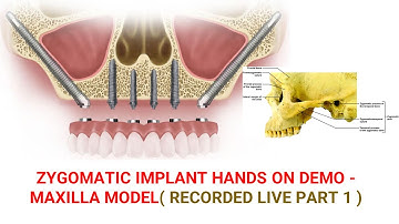 Zygomatic Implant  Hands on Demo - Maxilla Model( Recorded Live Part 1 ) – Dr. Rohan Virani