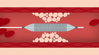 Heart Stent Procedure screenshot 5