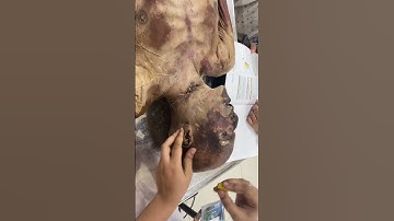 Head and neck surface marking