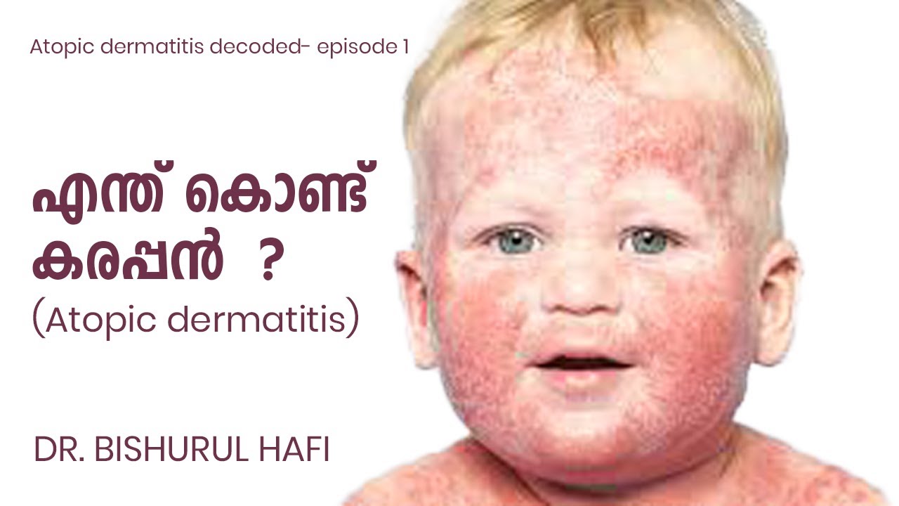 എന്താണ് കരപ്പൻ (Atopic dermatitis)? |Atopic dermatitis decoded- episode 1 | Dr. Bishurul Hafi