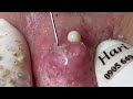 Blackheadspimpleswhiteheads removal with haris   satisfying
