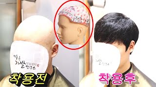 원형 탈모 & 확산성 탈모 → 반 전체가발!