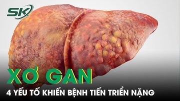 Bác Sĩ Chỉ Ra 4 Yếu Tố Khiến Bệnh Xơ Gan Tiến Triển Nặng |SKĐS