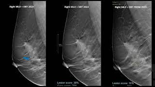 Case 3: Dr. A case study of a 51 year old woman recalled from screening due to a suspicious finding