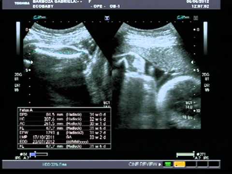 34 semanas de embarazo gemelar bicorial 34 semanas de embarazo gemelar bicorial
