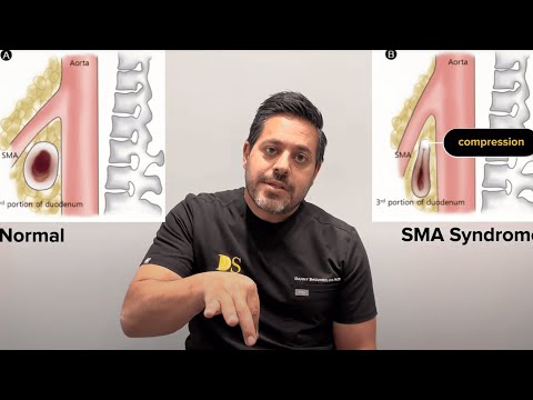 SMA/Superior Mesenteric Artery