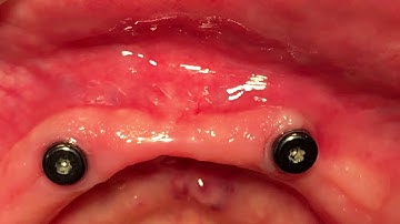 Straumann : Temporally Mandibular overdenture retained by two Novaloc® abutments