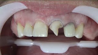 🔴PASSO A PASSO RECONTRUÇÃO DENTAL: ESTRATIFICAÇÃO COMPLETA!🤩🤩🤩🤩🤩