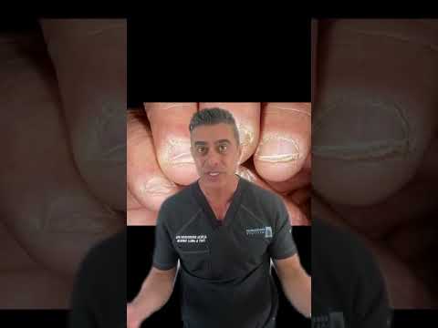 Video: Är nagelbitning en störning?