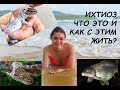 Ихтиоз. Что это такое и как с этим жить?