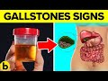 Symptoms Of Gallstones And How You Can Prevent Them