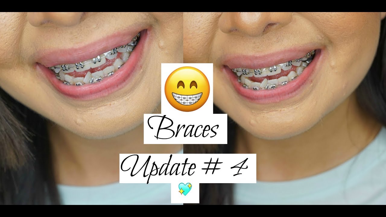 BRACES UPDATE 4 MONTHS PLUS Q A YouTube