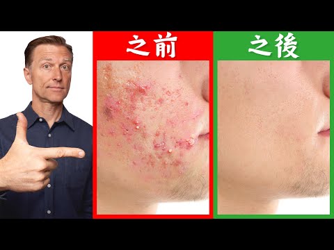 快速消除痘痘與疤痕,柏格醫生 Dr Berg