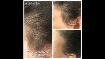 Scalp Micropigmentation - Facelift Scar Camouflage, Facelift Scar Repair