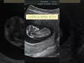 10주차 아기 초음파🍼 #임신 #임신초기 #임신기록 #임신초음파 #임신정보 #baby #pregnancy #pregnancyultrasound