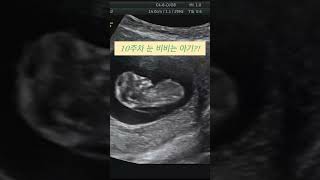 10주차 아기 초음파🍼 #임신 #임신초기 #임신기록 #임신초음파 #임신정보 #baby #pregnancy #pregnancyultrasound