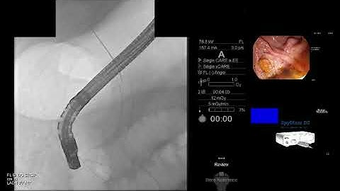 GastroLearning Express: ERCP Tips for Removing Proximally Migrated Biliary Stents