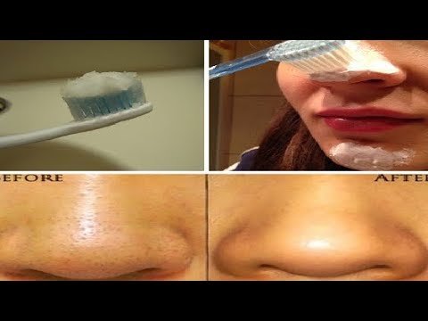 lactancia crisis ELIMINA PUNTOS NEGROS CON PASTA DE DIENTES??? FUNCIONA???