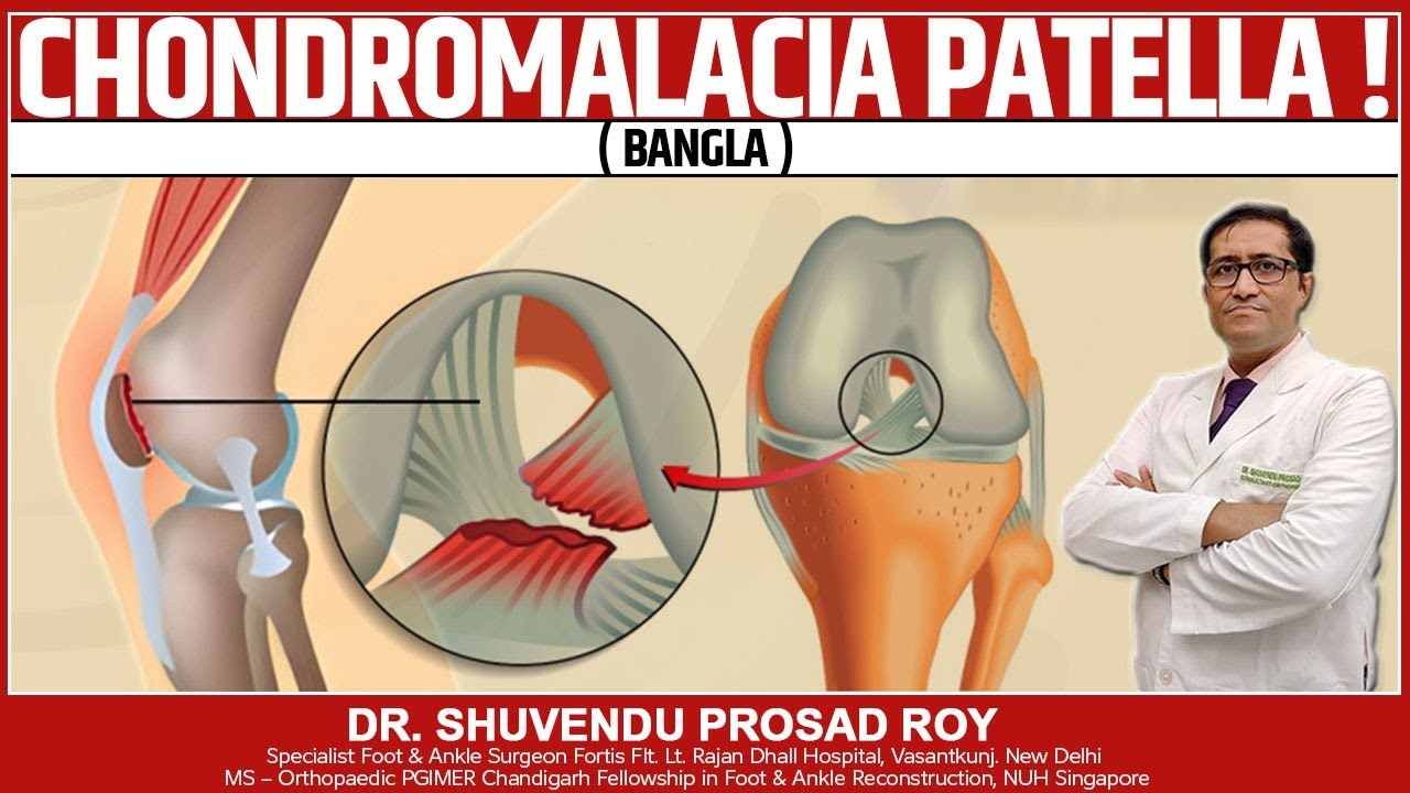 Chondromalacia Patella ! ( BANGLA ) Dr. Shuvendu Prosod Roy YouTube