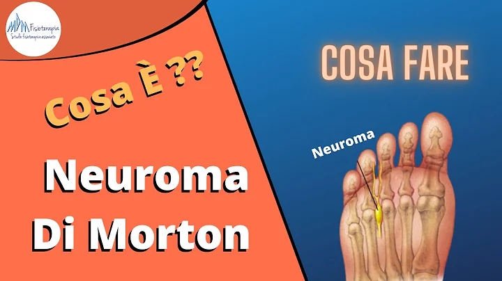 Neuroma di Morton cosa , come si cura