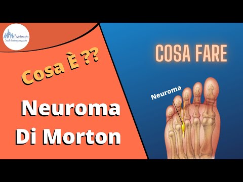 Video: Neuroma Di Morton: Cause, Trattamento E Altro