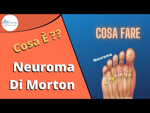 Neuroma di Morton cosa è, come si cura