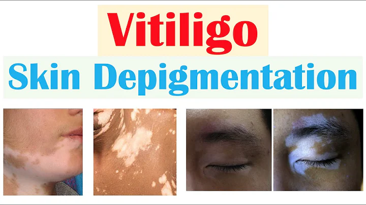 Vitiligo (Skin Depigmentation) | Pathophysiology, Signs and Symptoms, Diagnosis, Treatment - DayDayNews