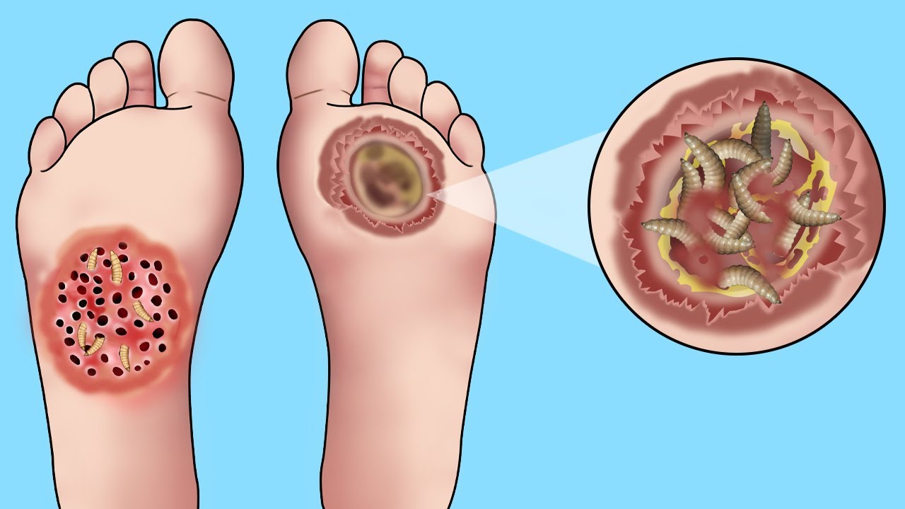 ASMR Maggots Treatment For Diabetic Wound Treatment For Foot Ulcer 