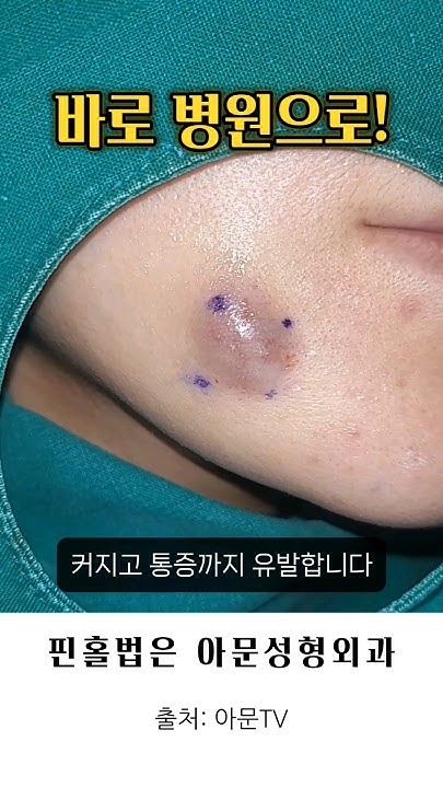 얼굴 종기, 불룩한 멍울이 아프다? (핀홀법 염증성 피지낭종 표피낭종 수술 성형외과 병원 Epidermal Cyst ...