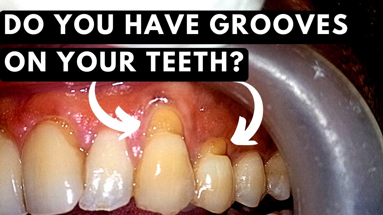 Brushing too hard can lead to this Teeth abrasion YouTube