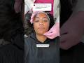 Entire 7 day chemical peel shedding process for hyperpigmentation on brown skin chemicalpeel