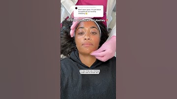 ENTIRE 7 Day chemical peel shedding process for hyperpigmentation on brown skin‼️🫶🏽 #chemicalpeel