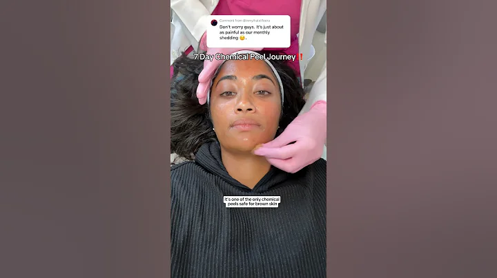 ENTIRE 7 Day chemical peel shedding process for hyperpigmentation on brown skin‼️🫶🏽 #chemicalpeel