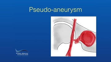 Endovascular Treatment of a Femoral Pseudo-aneurysm